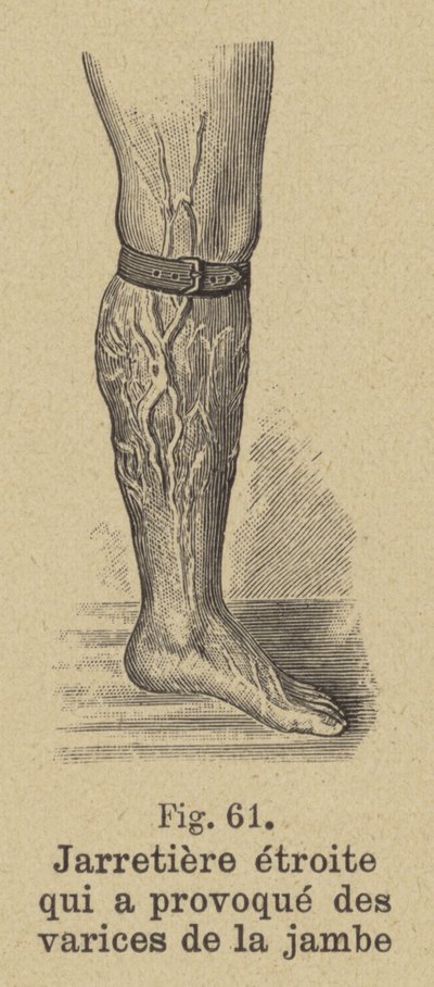Tight garter causing varicose veins in the leg by German School